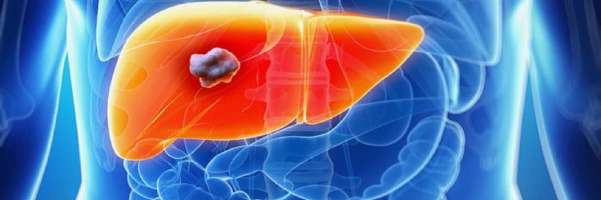 Karaciğer Kanseri: Sık Sorulan Sorulara Yanıtlar