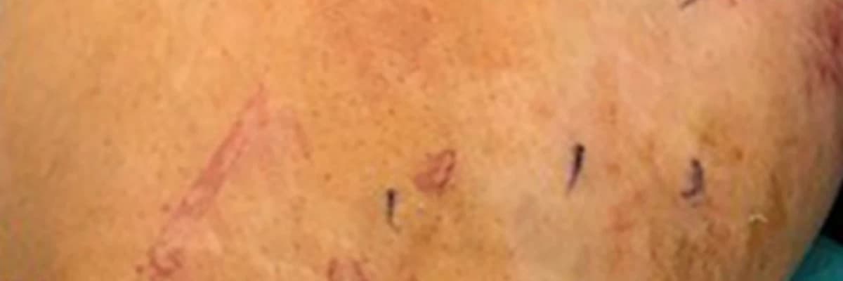 Efficiency of Prophylactic Ablation of the Tributary Venous Pathways Draining Around the Saphenofemoral Junction to Decrease the Rate of Future Varicose Vein and Symptoms Occurence