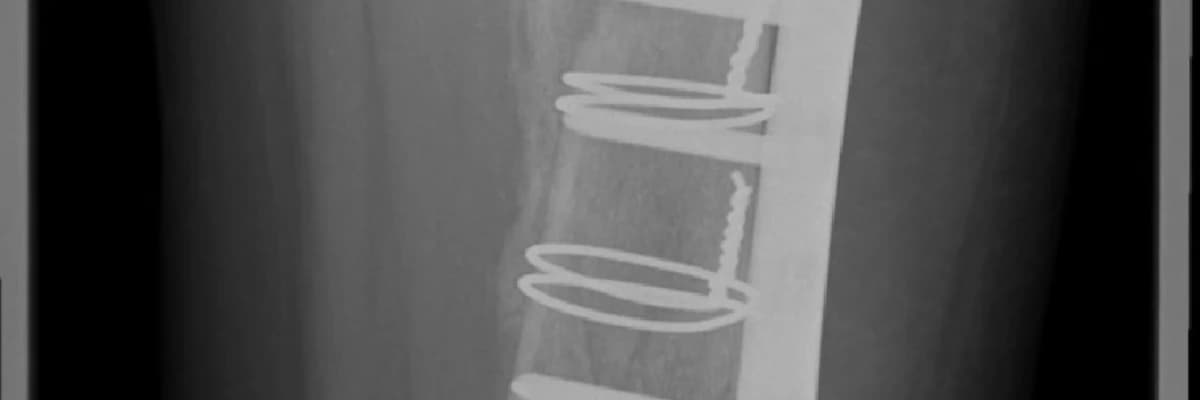 KIRIK İYİLEŞMESİ- Sessiz Mucize