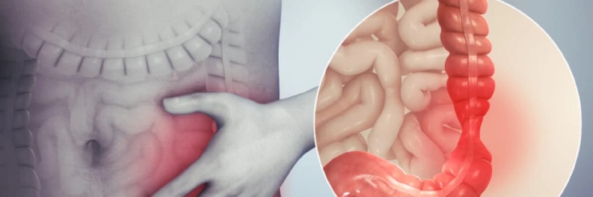 IBS, Düzensiz Bağırsak Sendromu Nedir?