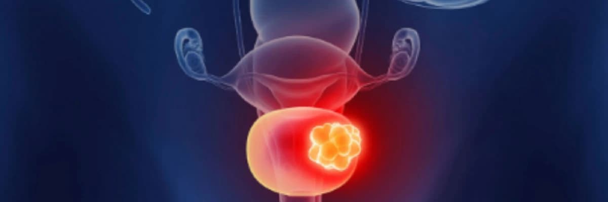 Mesane Kanseri Hakkında