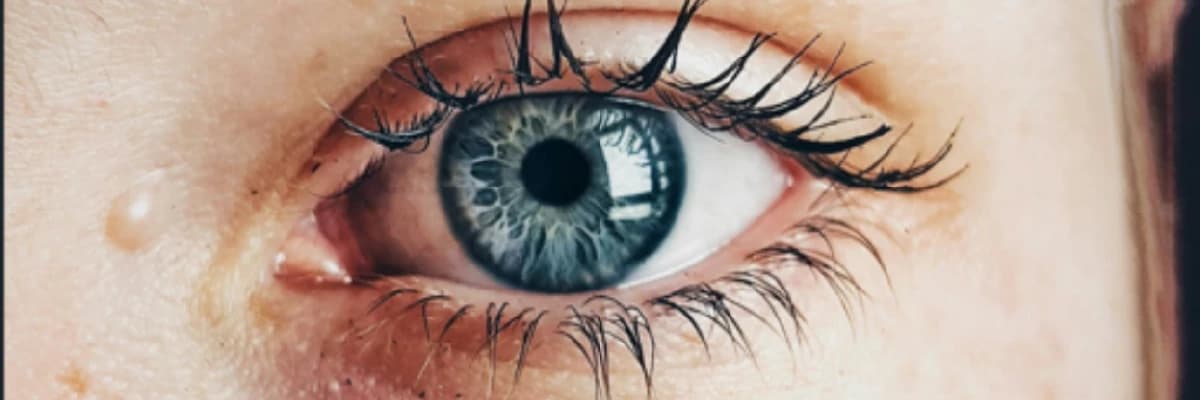 GÖZALTI KARARMASI VE RENK DEĞİŞİKLİKLERİ