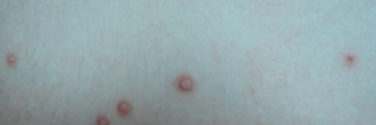 MOLLUSCUM CONTAGİOSUM