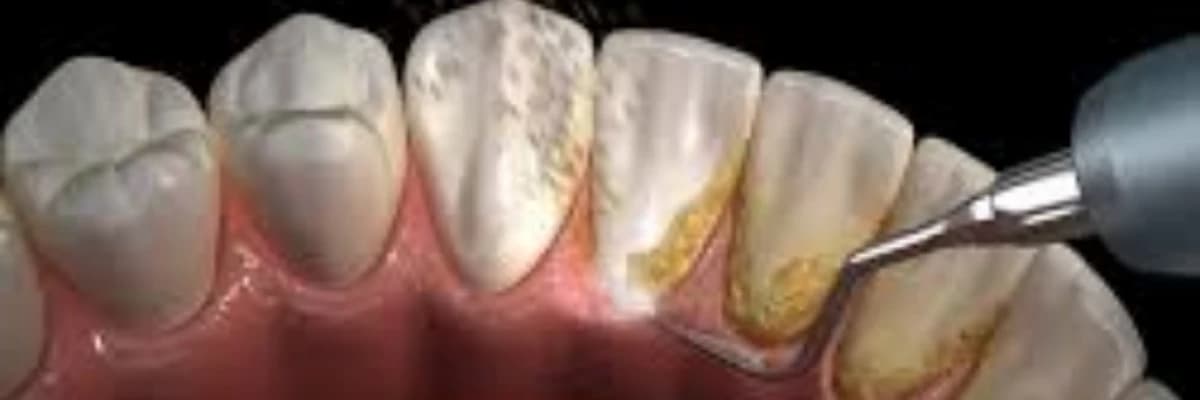 DİŞ TAŞI TEMİZLİĞİ NEDİR?