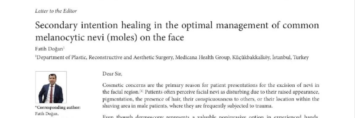 Secondary intention healing in the optimal management of common melanocytic nevi (moles on the face