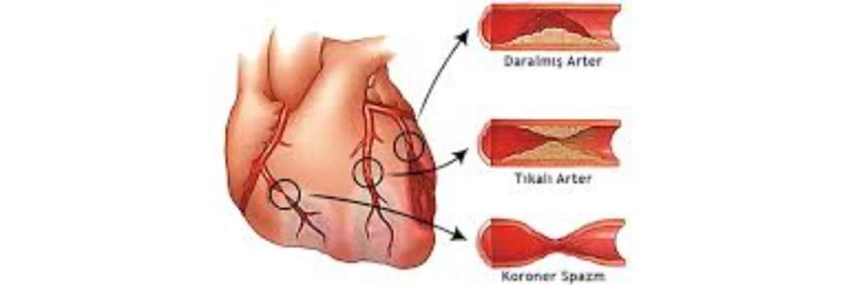 KORONER ARTER HASTALIĞI