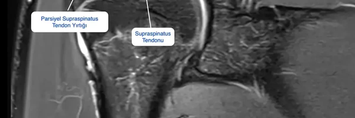 Rotator Manşet (Omuz Kas Yırtığı) Nedir?