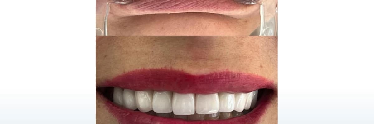 Zirkonyum Kaplama ve Gülüş Tasarımı