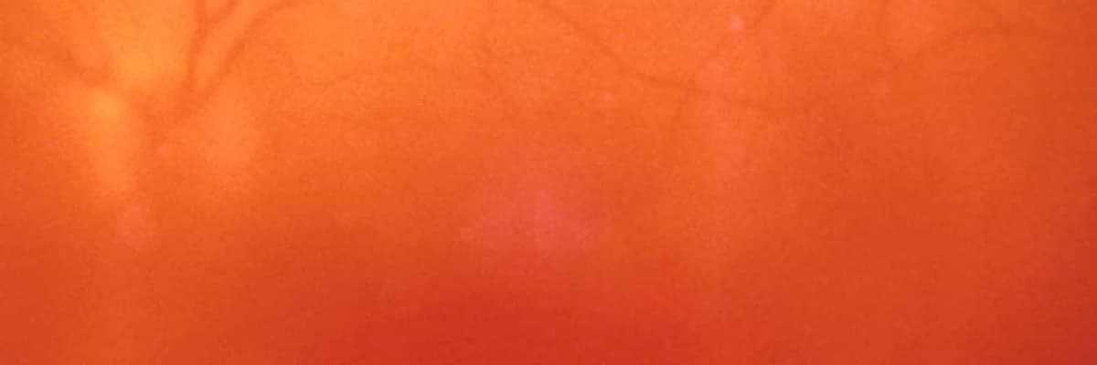 GÖZ İÇİ KANAMA (vitreus hemorajisi)