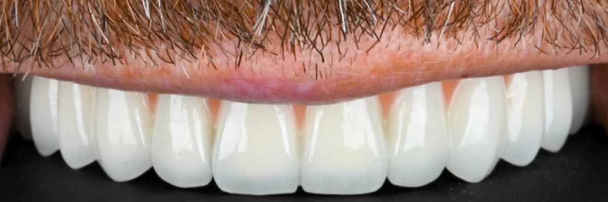 Zirkonyum Diş Nedir? Ne Kadar Dayanır, Doğal Görünür mü?