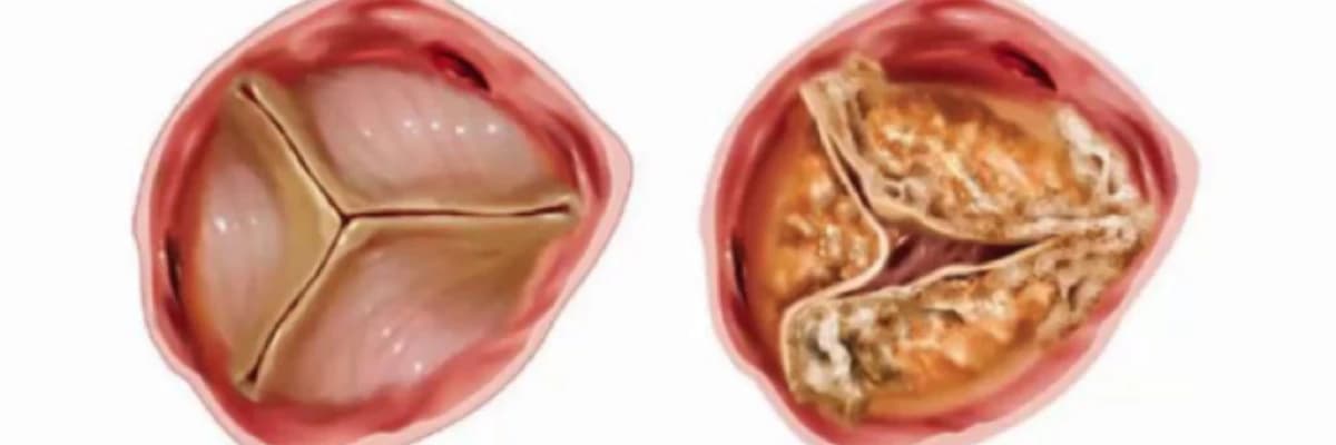 Aort darlığı nedir?