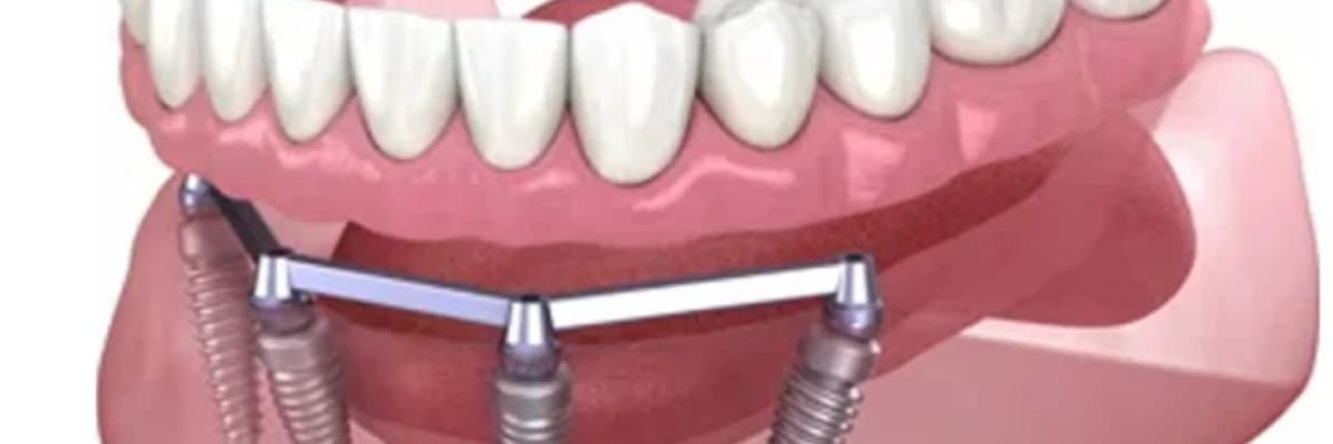 Hassas bağlantılı (Çıtçıtlı protez) nedir?