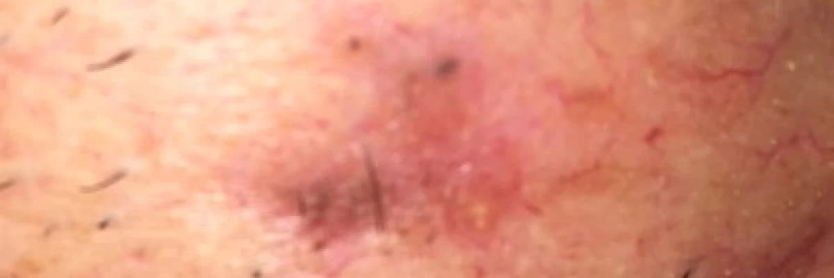 ERKEN EVRE MELANOM DIŞI DERİ KANSERİNDE (MDDK) KİŞİYE ÖZEL TEDAVİ Prof.Dr.Sıdıka Kurul Plastik Rekonstrüktif ve Estetik Cerrahi Uzmanı skurul@estet.net