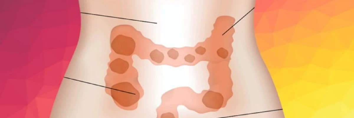 Dışkınızın Sağlık Durumunuz ile İlgili Söyleyebileceği 5 Şey