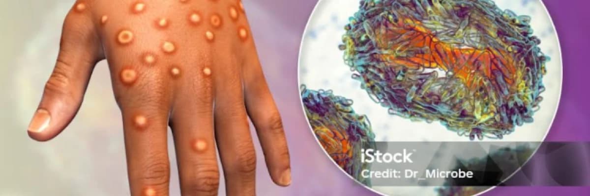 Monkeypox (Maymun Çiçeği Virüsü)