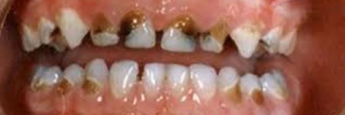 Çocuk Diş Hekimi ile İlk Buluşma