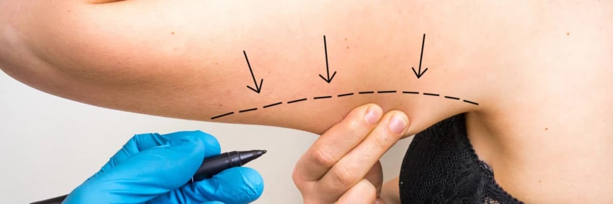 Kol Germe Ameliyatı Nedir?