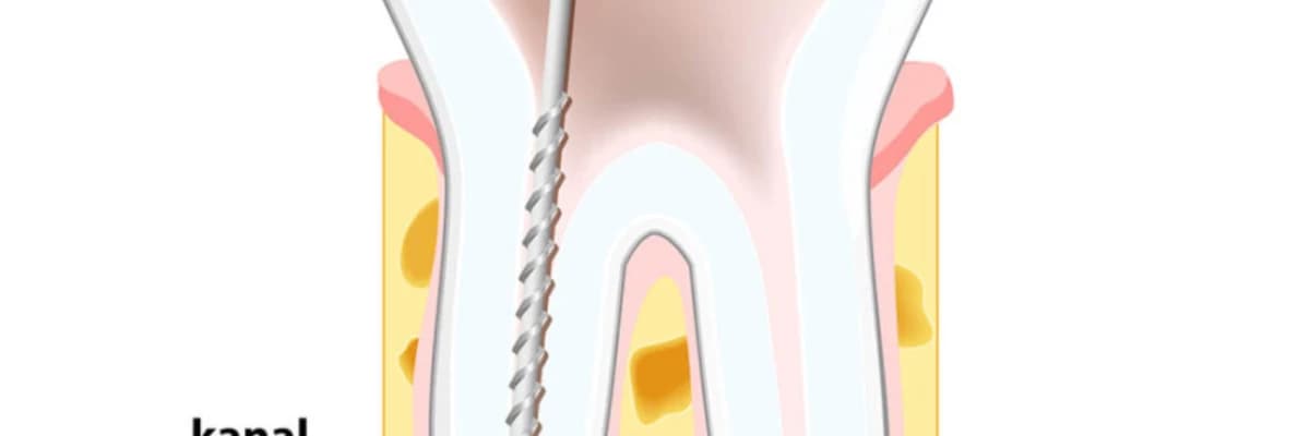 KANAL TEDAVİSİNDE BAŞARISIZLIK NEDENLERİ