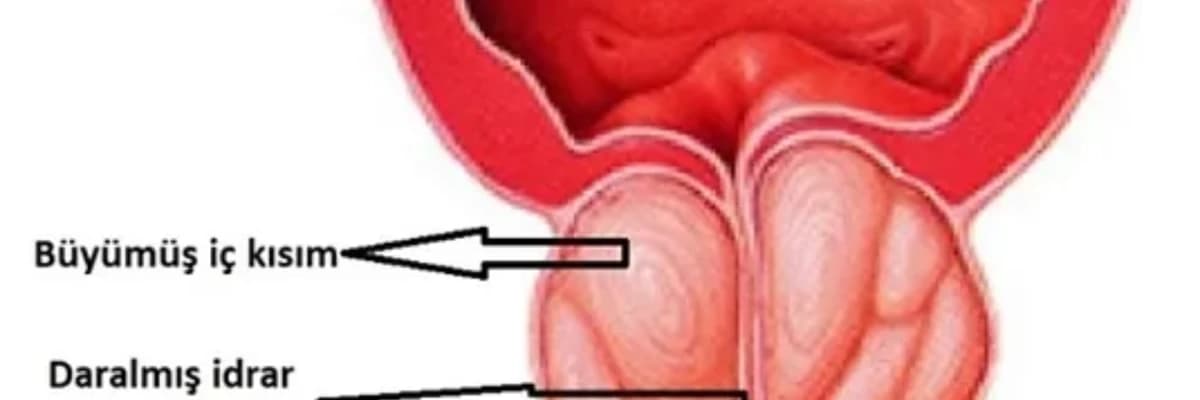 İYİ HUYLU PROSTAT BÜYÜMESİ (BENİGN PROSTAT HİPERPLAZİSİ, BPH)