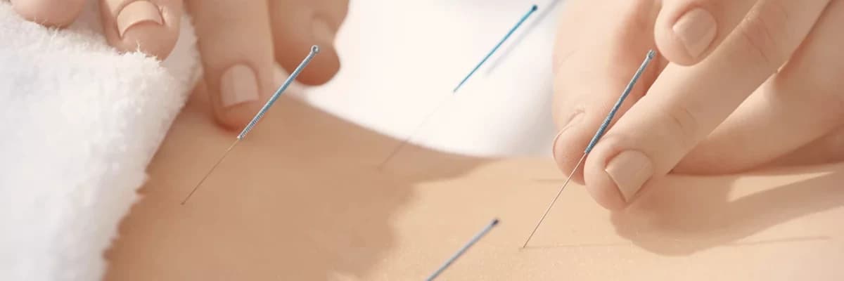 Akupunktur nedir? Etkileri nelerdir?