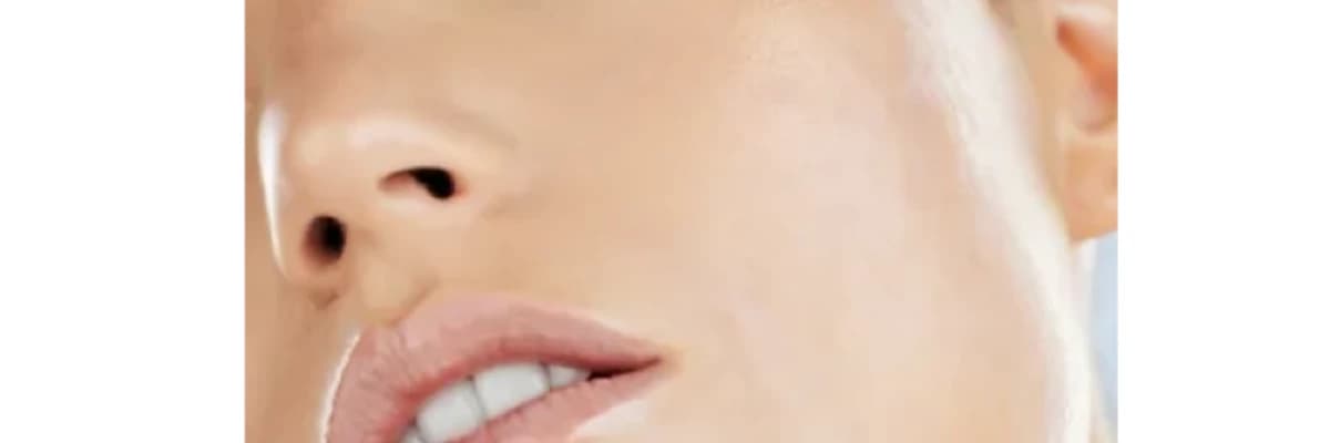 Çene Hattı (Jawline) Dolgusu
