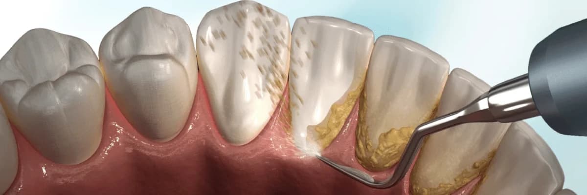 DİŞ TAŞI TEMİZLİĞİ