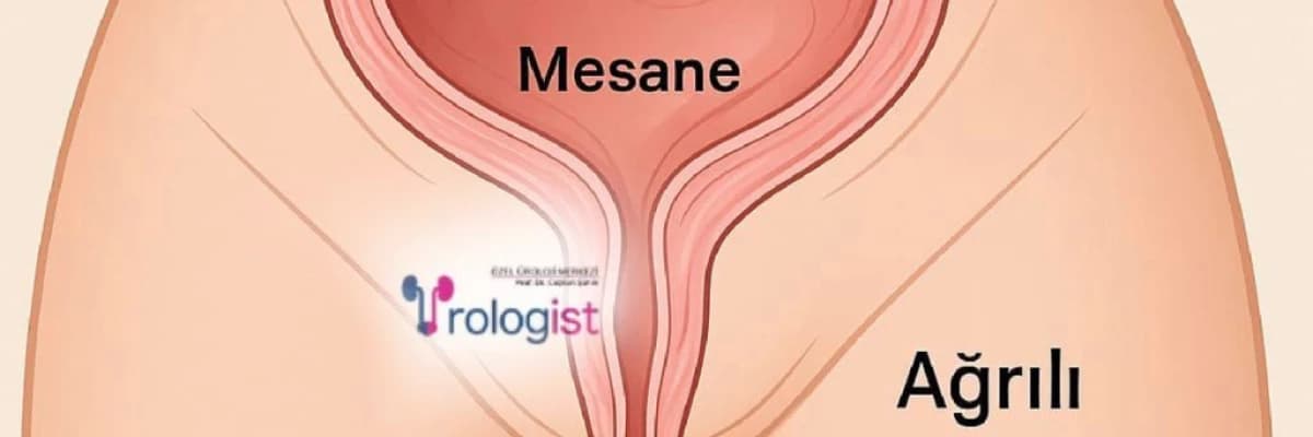 KADINLARDA MESANE DARLIĞI NEDİR? AĞRILI İDRAR YAPMA | SESSİZ BİR RAHATSIZLIK