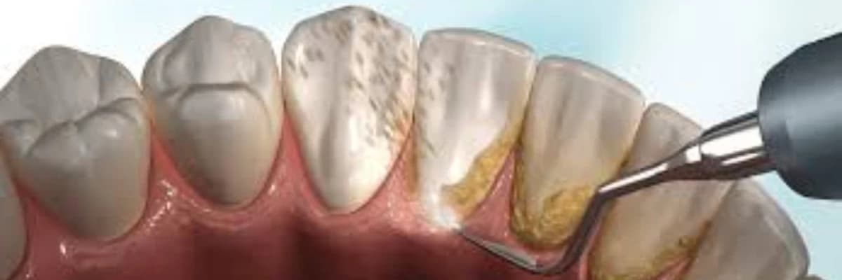 Diş Taşı Temizliği Neden Önemli?