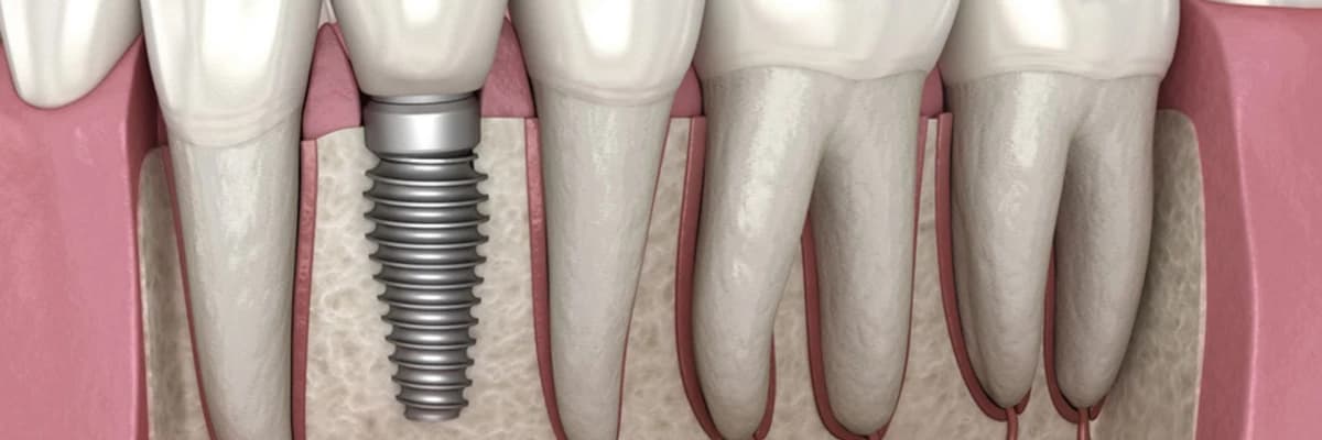 Diş Hekimliğinde Zirkonyum Uygulamaları