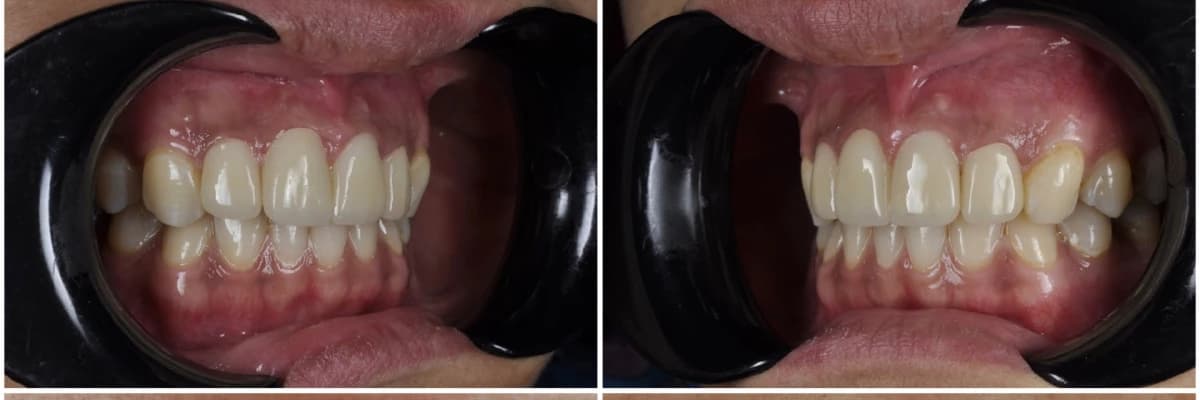 Diş Hekimliğinde Kullanılan Zirkonyum Materyaller