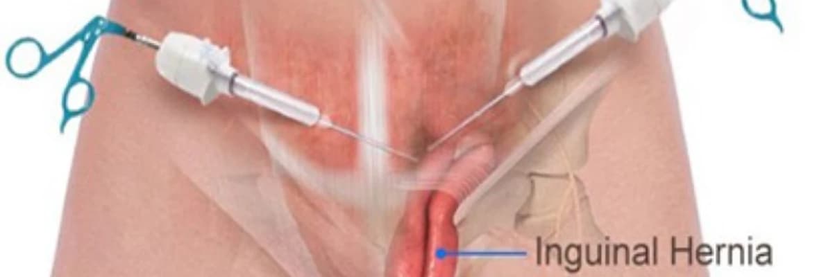 Laparoskopik İnguinal Herni Ameliyatı: Minimal İnvaziv Cerrahi Teknikle Sağlığınıza Kavuşmak