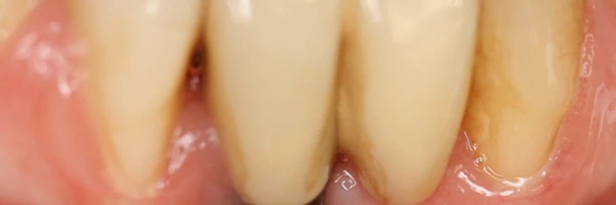 İmplant Sonrası Ağız Hijyeni ve Peri-implantitis