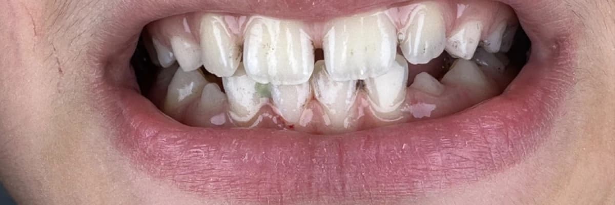 Beyazlatıcı diş macunları hakkında merak edilenler