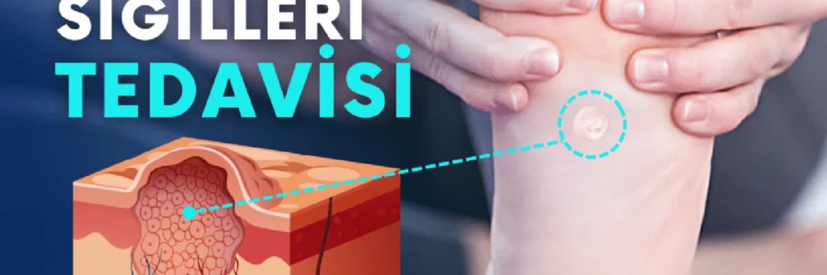 Siğil Tedavisi Hakkın da En Çok Merak Edilenler