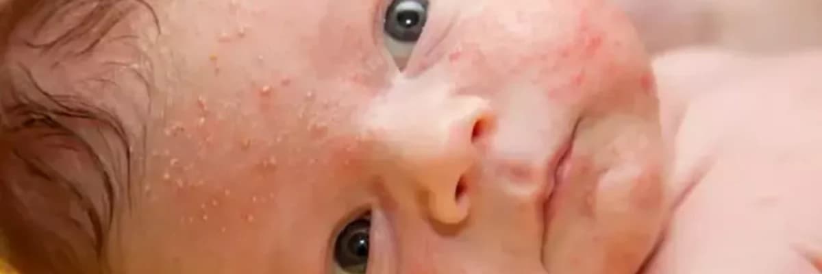 İsiliğe ne iyi gelir?