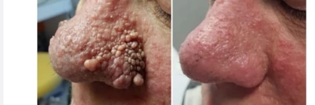 FRAKSİYONEL CO ² LAZER SİSTEMLERİ