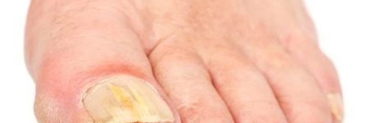🍄 Ayak Mantarı mı Egzama mı? Ayağınızdaki Soyulma ve Kaşıntının Gerçek Nedeni Ne? 🦶