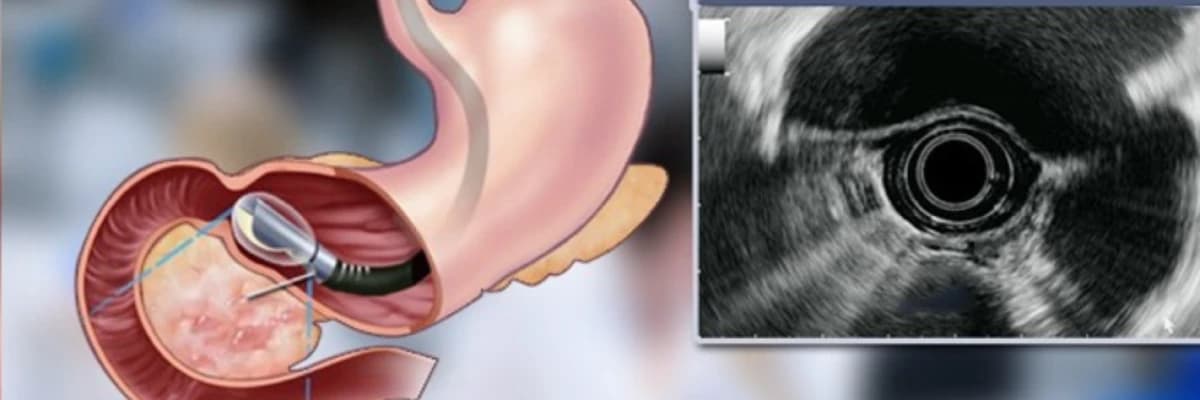 EUS Nedir ? Hangi durumlarda yapılır ?