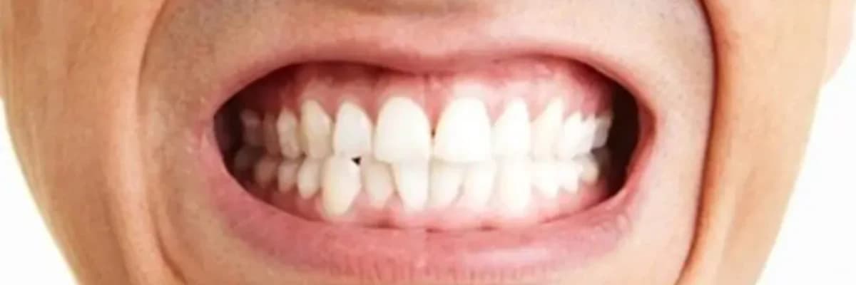 🌙 Diş Sıkma ve Gıcırdatma (Bruksizm)