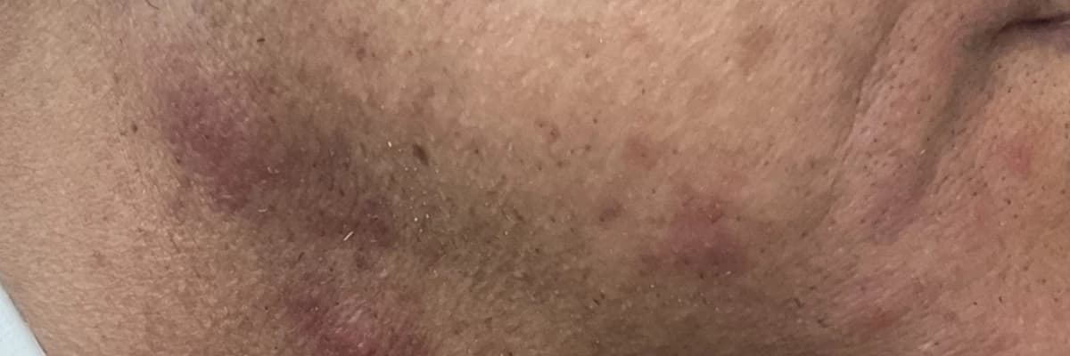 PSODOFOLİKÜLİTİS BARBA YANİ TIRAŞ ŞİŞLİKLERİ