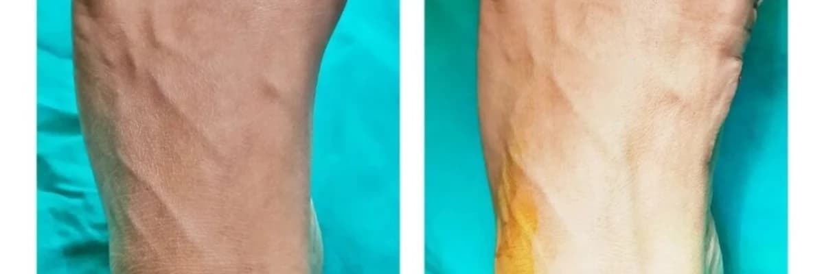 HALLUKS VALGUS / AYAK BAŞPARMAK ÇIKINTISI