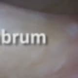 Right versus left hip arthroscopy for surgeons on the learning curve