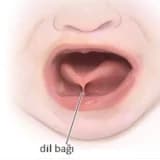 DİL BAĞI HİÇ KONUŞMAYAN ÇOCUKLARDA KONUŞMAYA ENGEL DEĞİLDİR