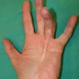 Dupuytren Hastalığı