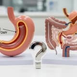 Tüp Mide Ameliyatı mı Gastrik by-pass mı? Bana hangi ameliyat uygun?