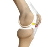 Patellar Tendinit ve Ön Diz Ağrısı