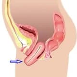 RAHİM SARKMASI VE TEDAVİ YÖNTEMLERİ
