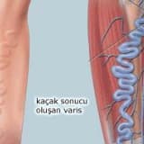 Varis tedavisinde kompleks bosaltıcı fizyoterapi