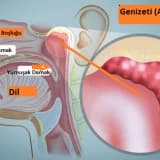 Geniz eti (adenoid vejetasyon)