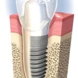 Eksik dişler ve implant